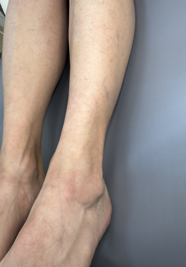 Рис. 2: голени той же пациентки после курса IPL-терапии