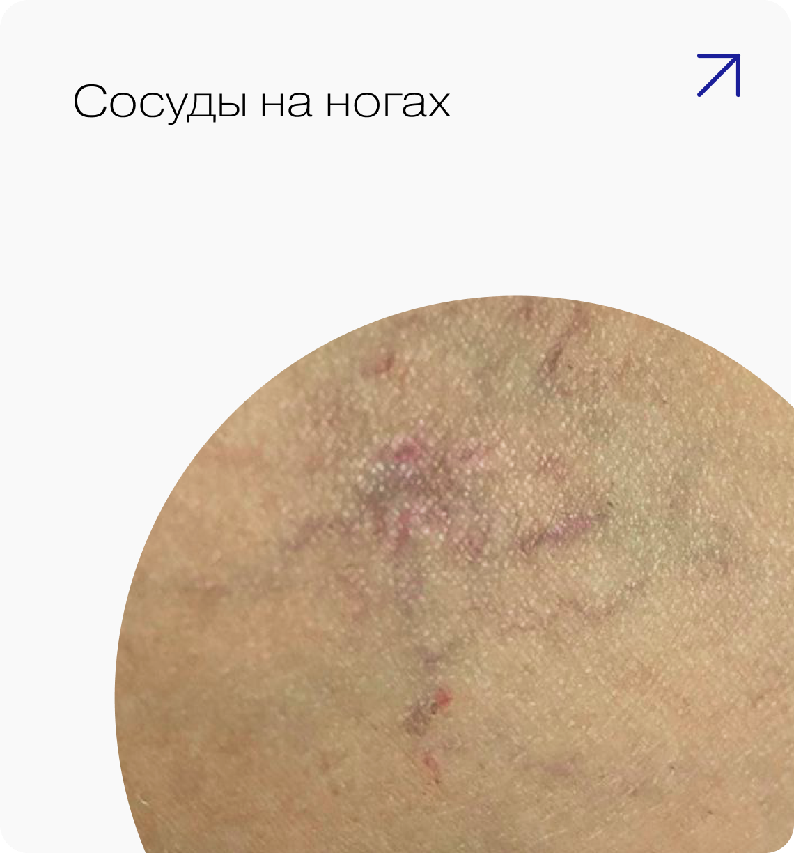 Сосуды на ногах — лечение на аппаратах Estetica