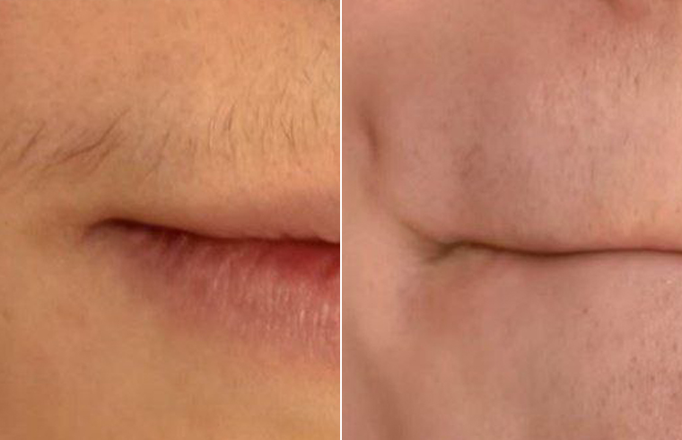Diode Estetica 3.0