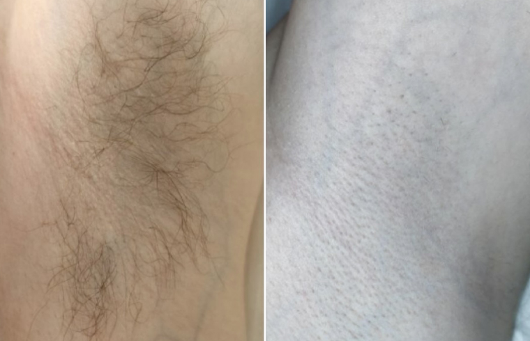 Diode Estetica 3.0