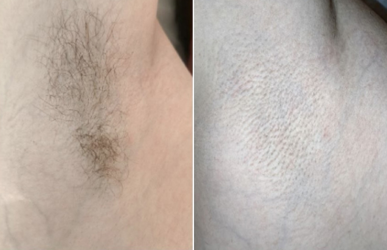 Diode Estetica 3.0