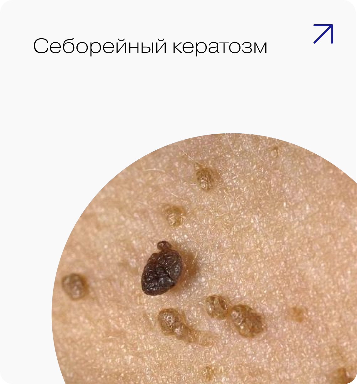Себорейный кератоз — лечение на аппаратах Estetica