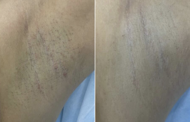 Diode Estetica 3.0