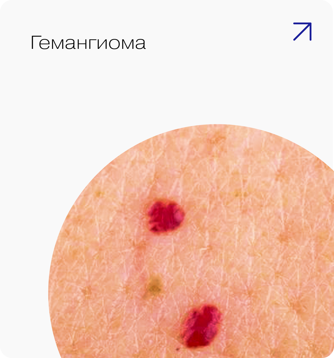 Гемангиома — лечение на аппаратах Estetica